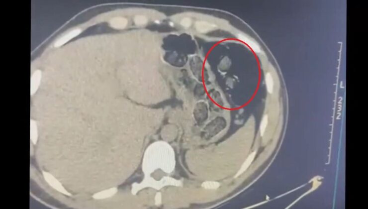 Midesinde 780 gram metamfetaminle yakalanan 2 şüpheli tutuklandı